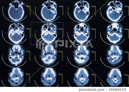 images from computerized tomography of the brain 16068529
