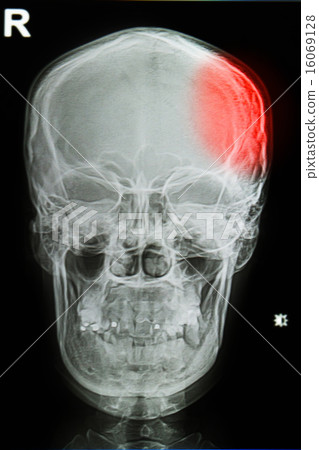 x-ray image of the painful or injury skull x-ray image of the painful or injury skull 16069128
