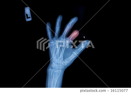 X-ray of trauma hand and finger X-ray of trauma hand and finger 16115077