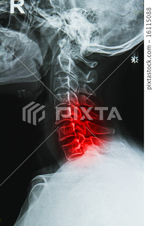 cervical spine neck x-ray image 16115088