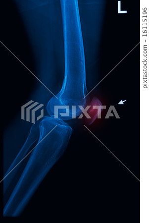 trauma knee joint x-rays image vertical 16115196