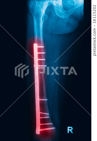 Fracture femur, femur x-rays image 16115202