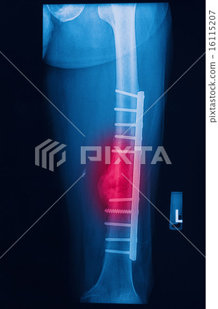 broken human thigh x-rays image broken human thigh x-rays image 16115207