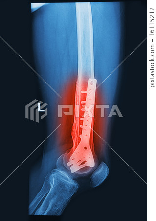 broken human thigh x-rays image with implant broken human thigh x-rays image with implant 16115212