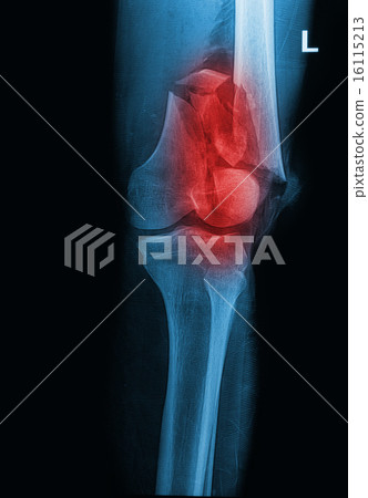 broken human thigh x-rays image ,lelf leg fracture 16115213