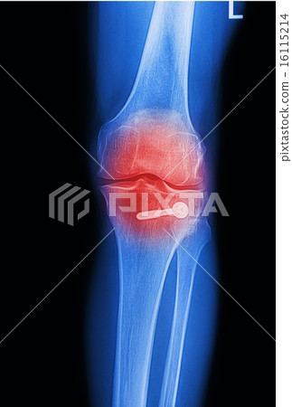 x ray image painful of knee joint 16115214