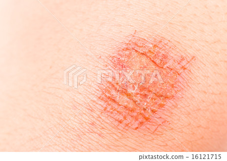 Close up on painful bruise wound on the knee Close up on painful bruise wound on the knee 16121715