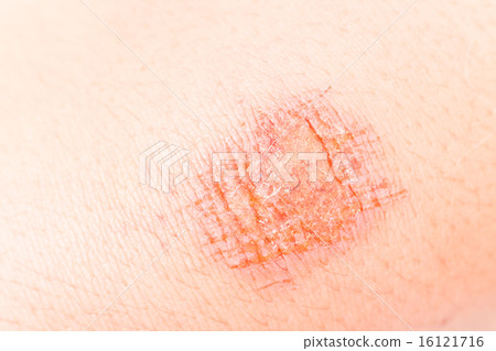 Close up on painful bruise wound on the knee Close up on painful bruise wound on the knee 16121716