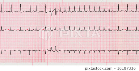 ECG with supraventricular arrhythmias  16197336