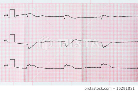 ECG after clinical death and resuscitation ECG after clinical death and resuscitation 16291851