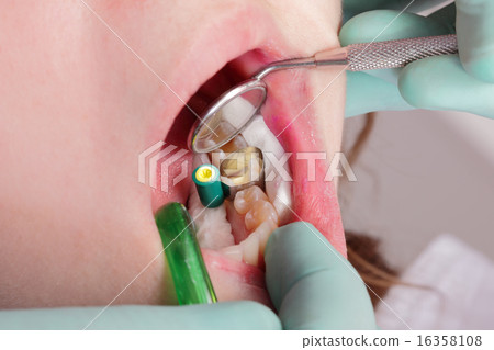 Dental procedure, tooth filling Dental procedure, tooth filling 16358108
