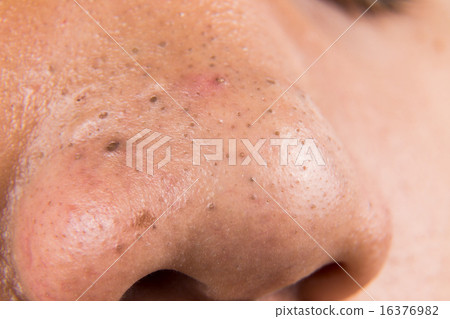 Pimple, acne and blackheads on teenager nose 16376982