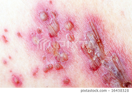 Herpes Zoster (Shingles) 16438328