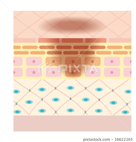 Skin cross sectional image image - spots, freckles 16622165
