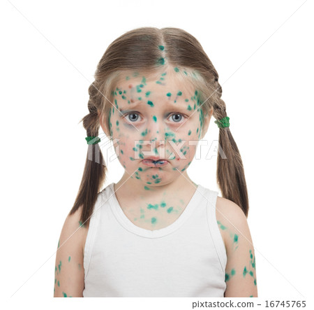 sick child. chickenpox 16745765