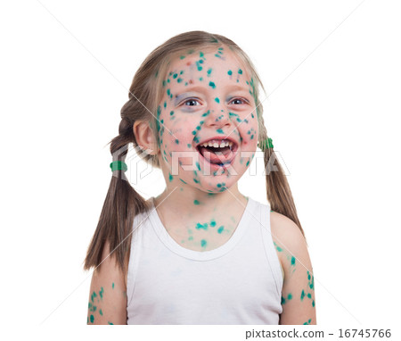 acnes on child. chickenpox 16745766