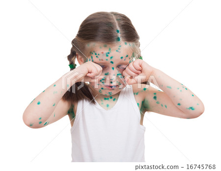 acnes on child. chickenpox 16745768