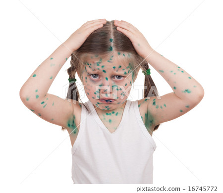 sick child. chickenpox 16745772