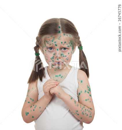sick child. chickenpox 16745776