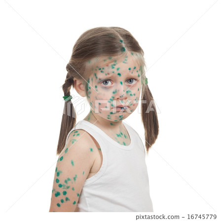 sick child. chickenpox 16745779