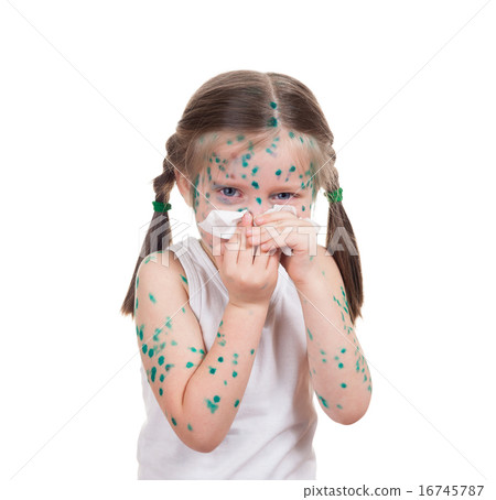 acnes on child. chickenpox 16745787