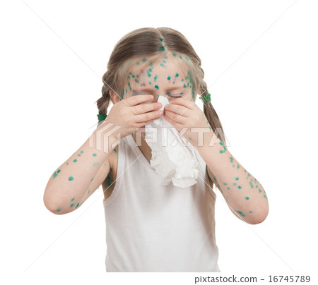 sick child. chickenpox 16745789
