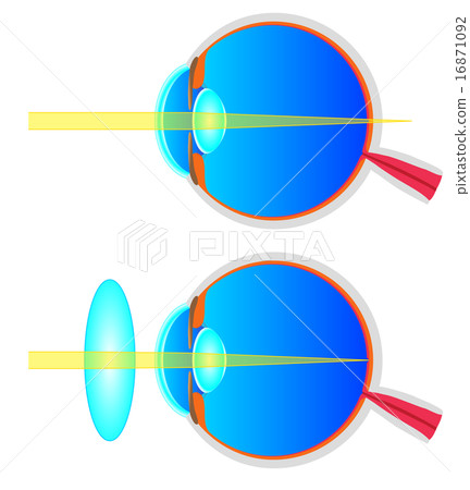 Cross sectional view of hyperopia 16871092