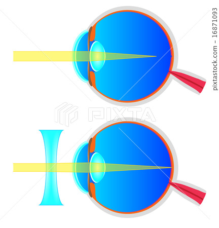 Cross sectional view of myopia 16871093