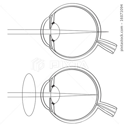 Cross sectional view of hyperopia 16871094