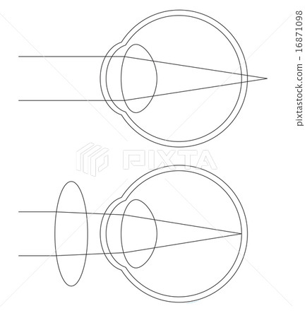Cross sectional view of hyperopia 16871098