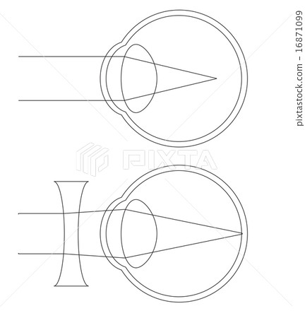 Cross sectional view of myopia 16871099