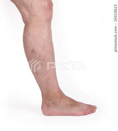 Old woman with varicose veins Old woman with varicose veins 16918623