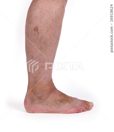 Old woman with varicose veins Old woman with varicose veins 16918624