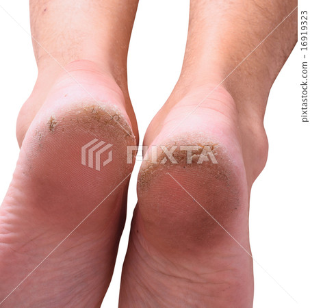 dry skin 16919323