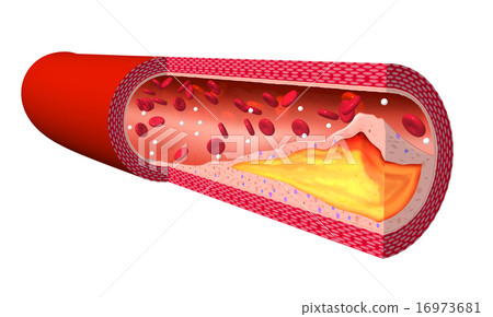 Atheroma blood vessel - Stock Illustration [16973681] - PIXTA