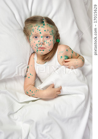 child has the virus on skin 17015629