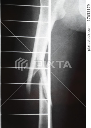 股骨骨折的X射線照片 股骨骨折的X射線照片 17053179