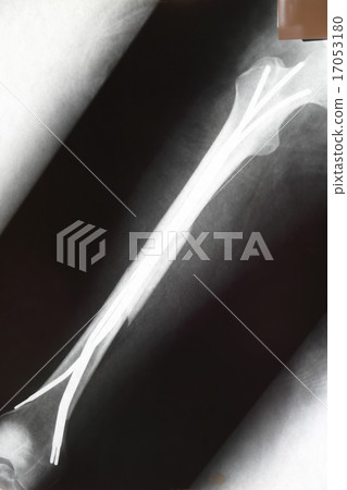 X-ray photograph after surgery of femoral fracture 17053180
