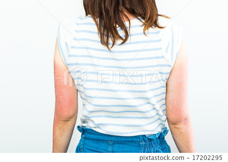 Female Japanese suntan suntan ultraviolet arm arrested sun tanned arm notice for summer midsummer inflammatory skin 17202295