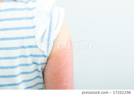 Female Japanese suntan suntan ultraviolet arm arrested sun tanned arm notice for summer midsummer inflammatory skin 17202296
