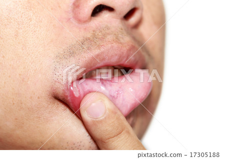 Man with serious aphtha on lip Man with serious aphtha on lip 17305188