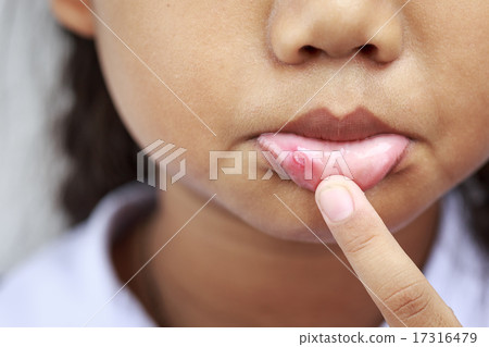 Children with aphtha on lip Children with aphtha on lip 17316479