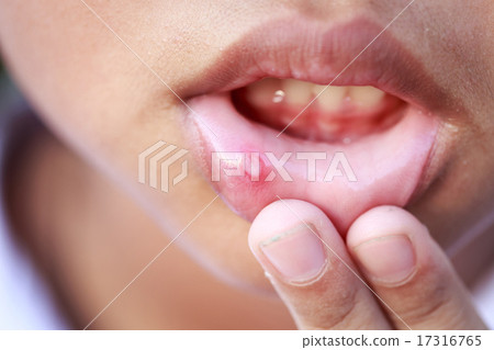 Children with aphtha on lip Children with aphtha on lip 17316765