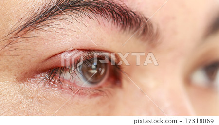 Right upper eye lid abscess "stye or hordeolum" 17318069