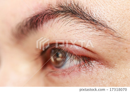 Left upper eye lid abscess "stye or hordeolum" 17318070