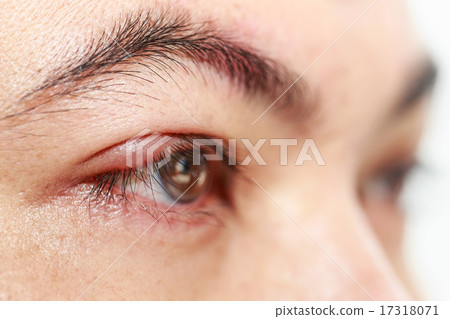 Right upper eye lid abscess "stye or hordeolum" 17318071