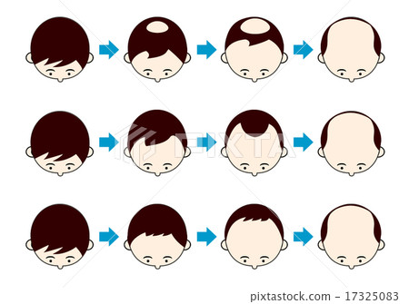 AGA的進展類型 AGA的進展類型 17325083