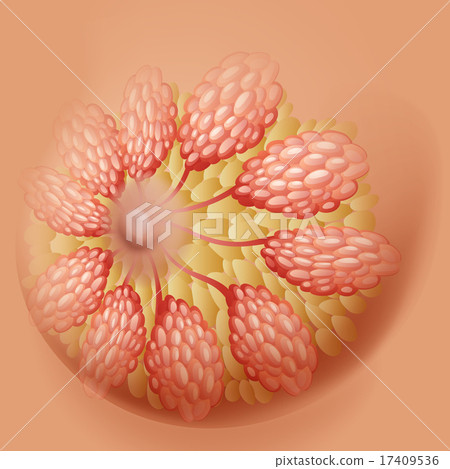 Breast cancer diagram in detail - Stock Illustration [17409536] - PIXTA
