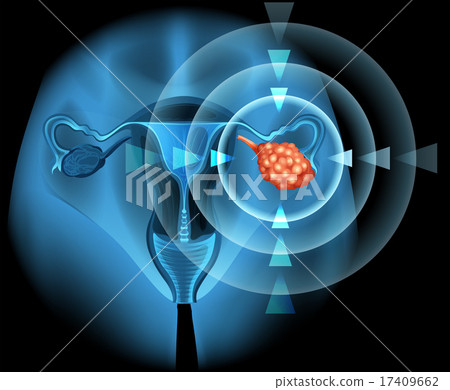 Overian cancer diagram in detail 17409662