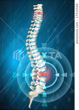 Human spine showing back pain 17410589